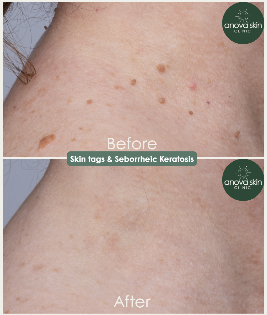 Before and after treating skin tags and seborrheic keratosis with diathermy at Anova Skin Clinic, Floreat Perth